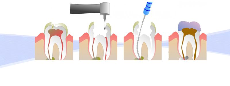 Endodonție